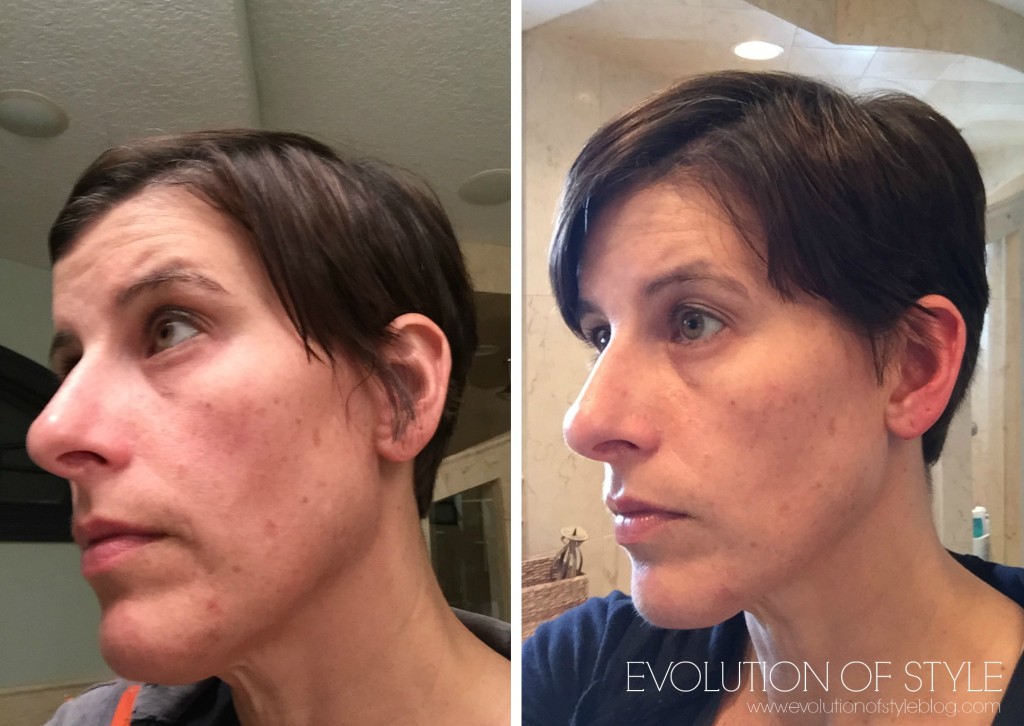 Rodan+Fields Skin Care Before and After